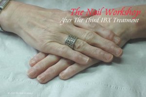 Third IBX Treatment
